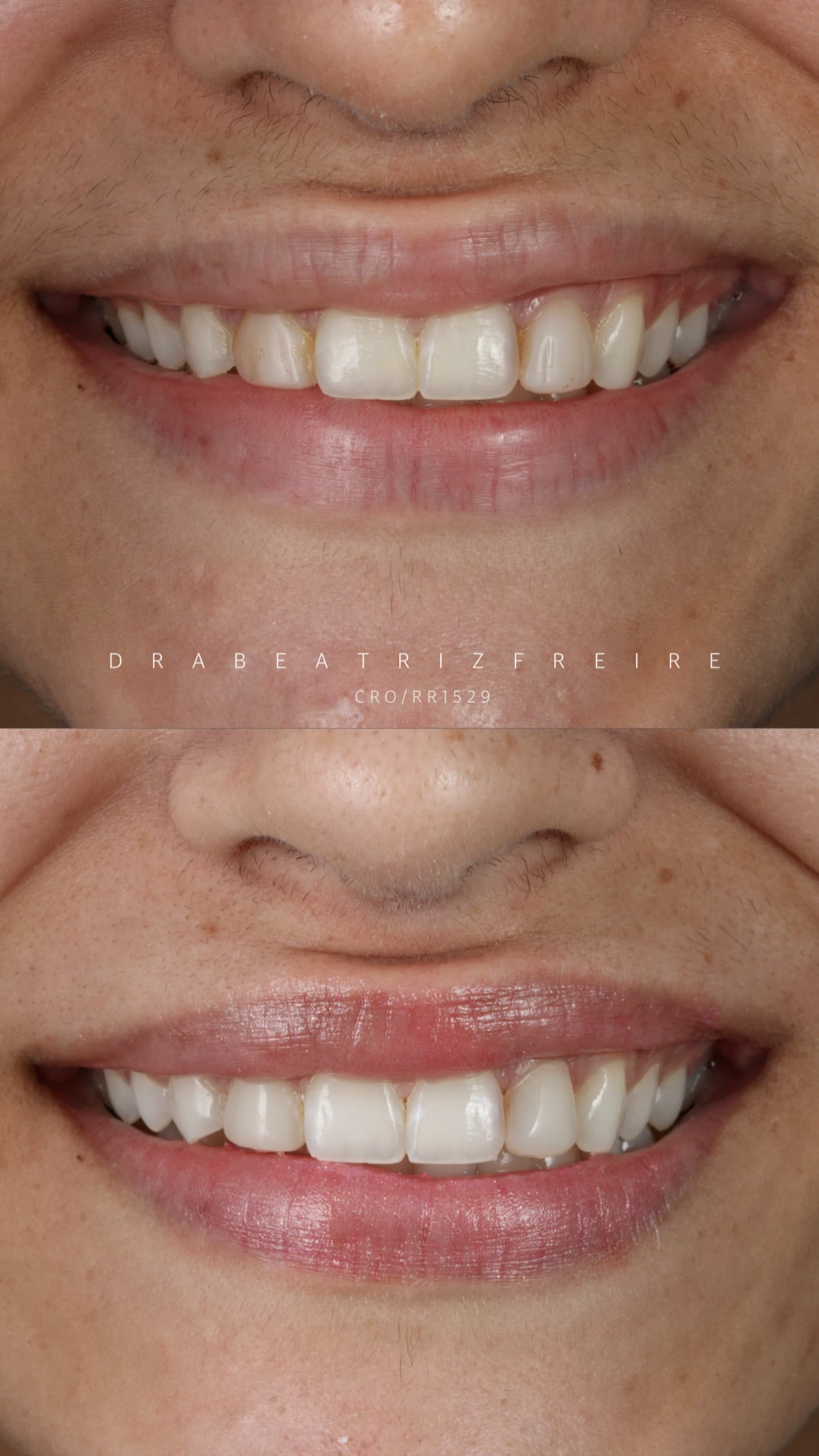 Clareamento Dental Premium - Foto 1