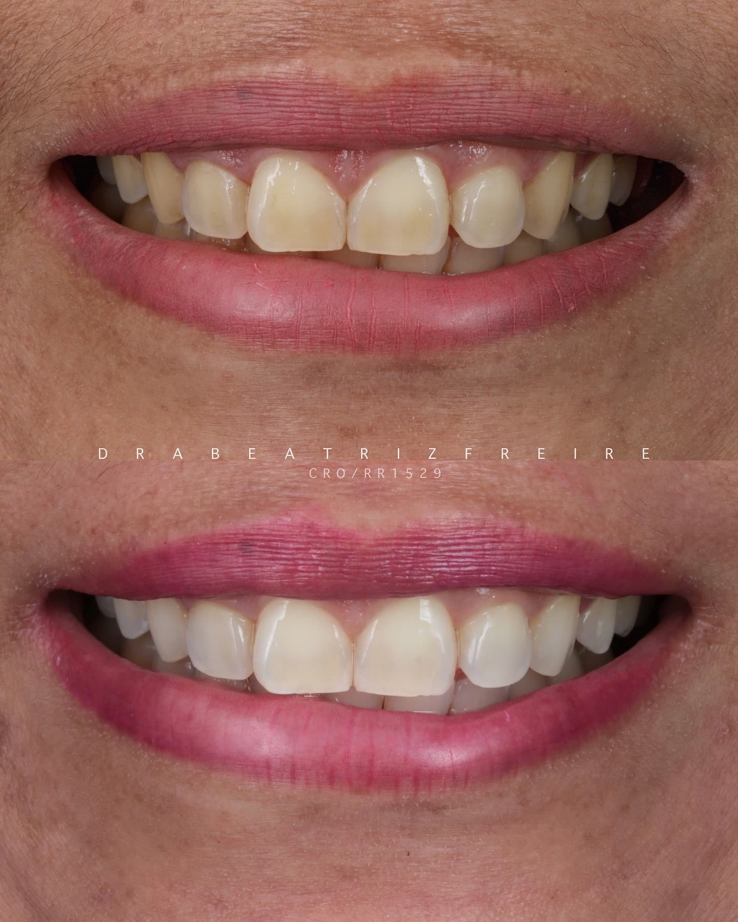 Clareamento Dental Premium - Foto 3
