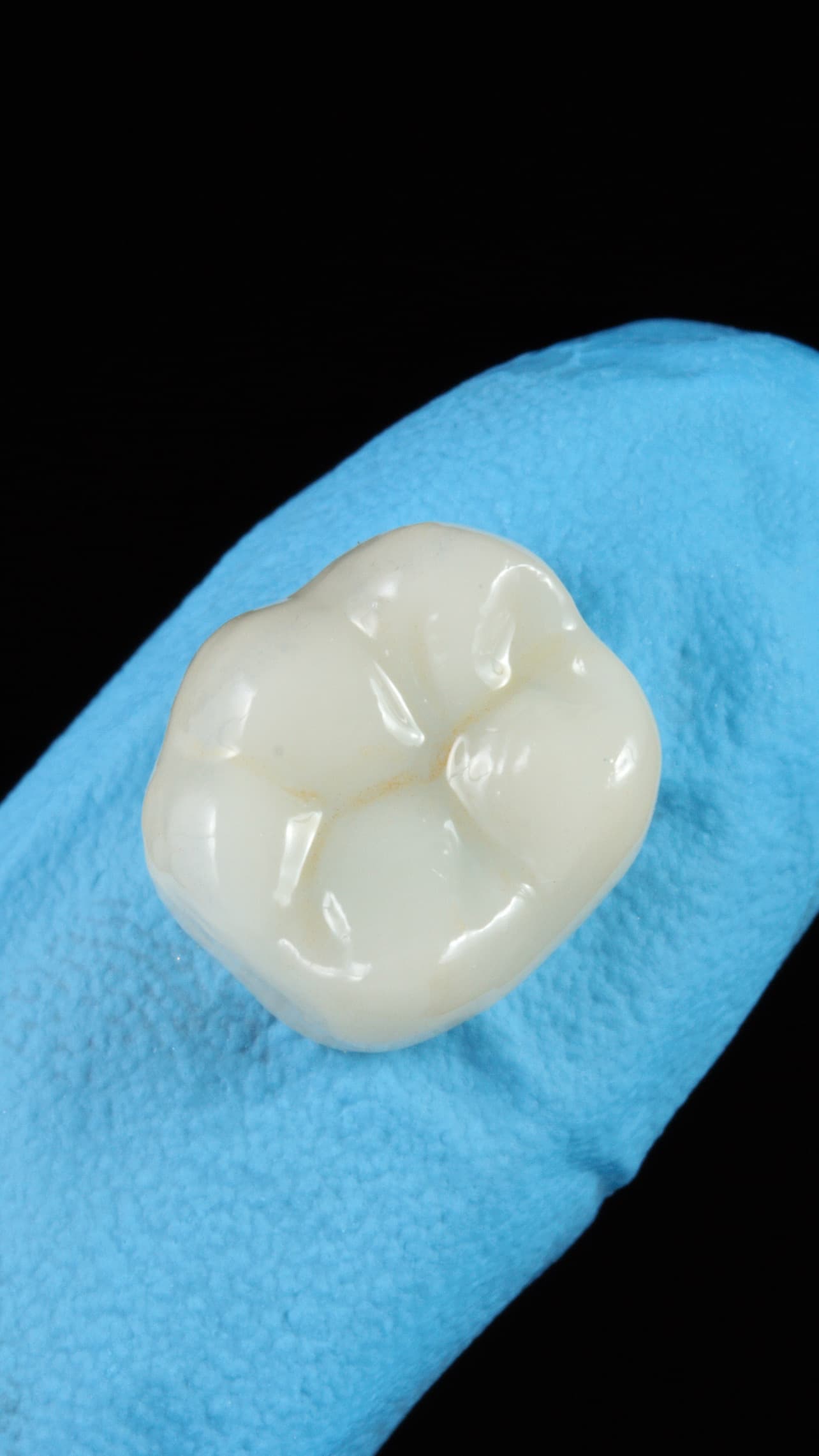 Reabilitação com Coroa - Foto 1