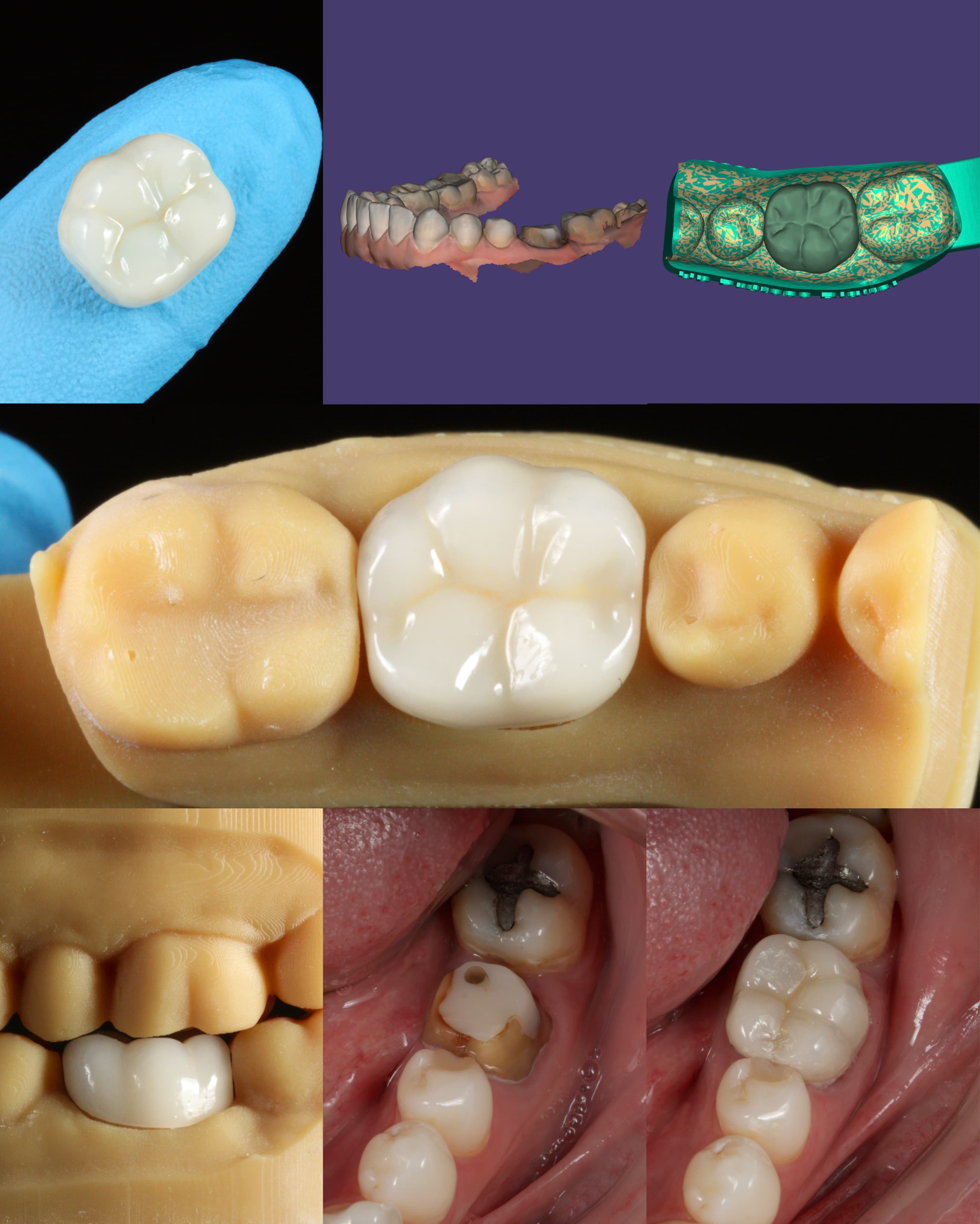 Reabilitação com Coroa - Foto 2