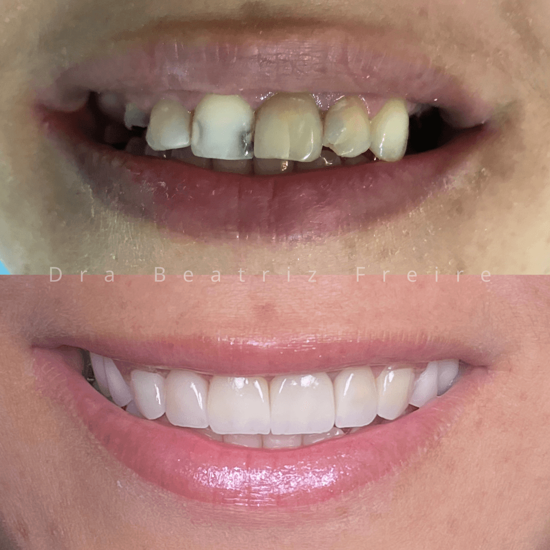 Lentes de Contato Dental - Foto 1