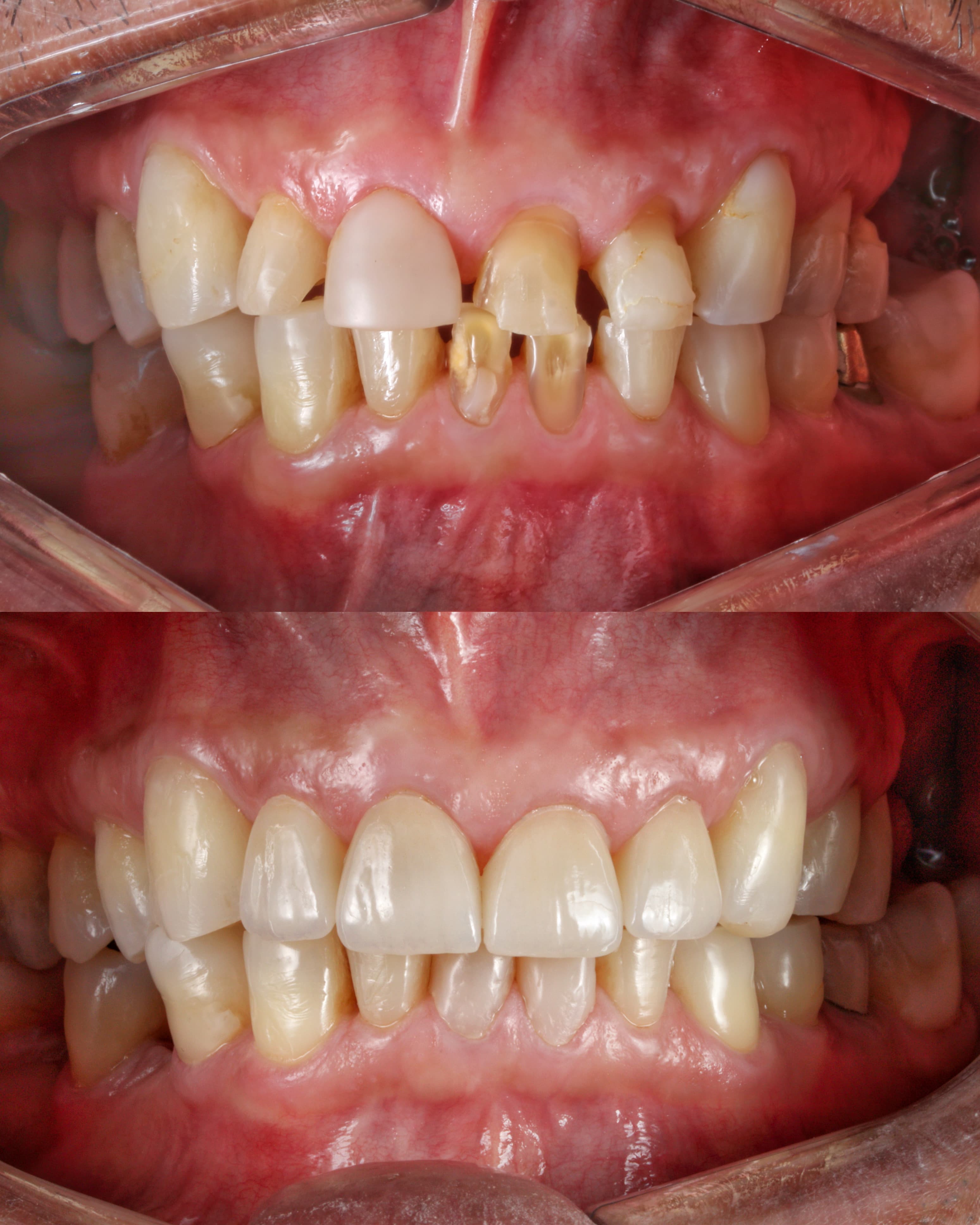 Lentes de Contato Dental - Foto 3