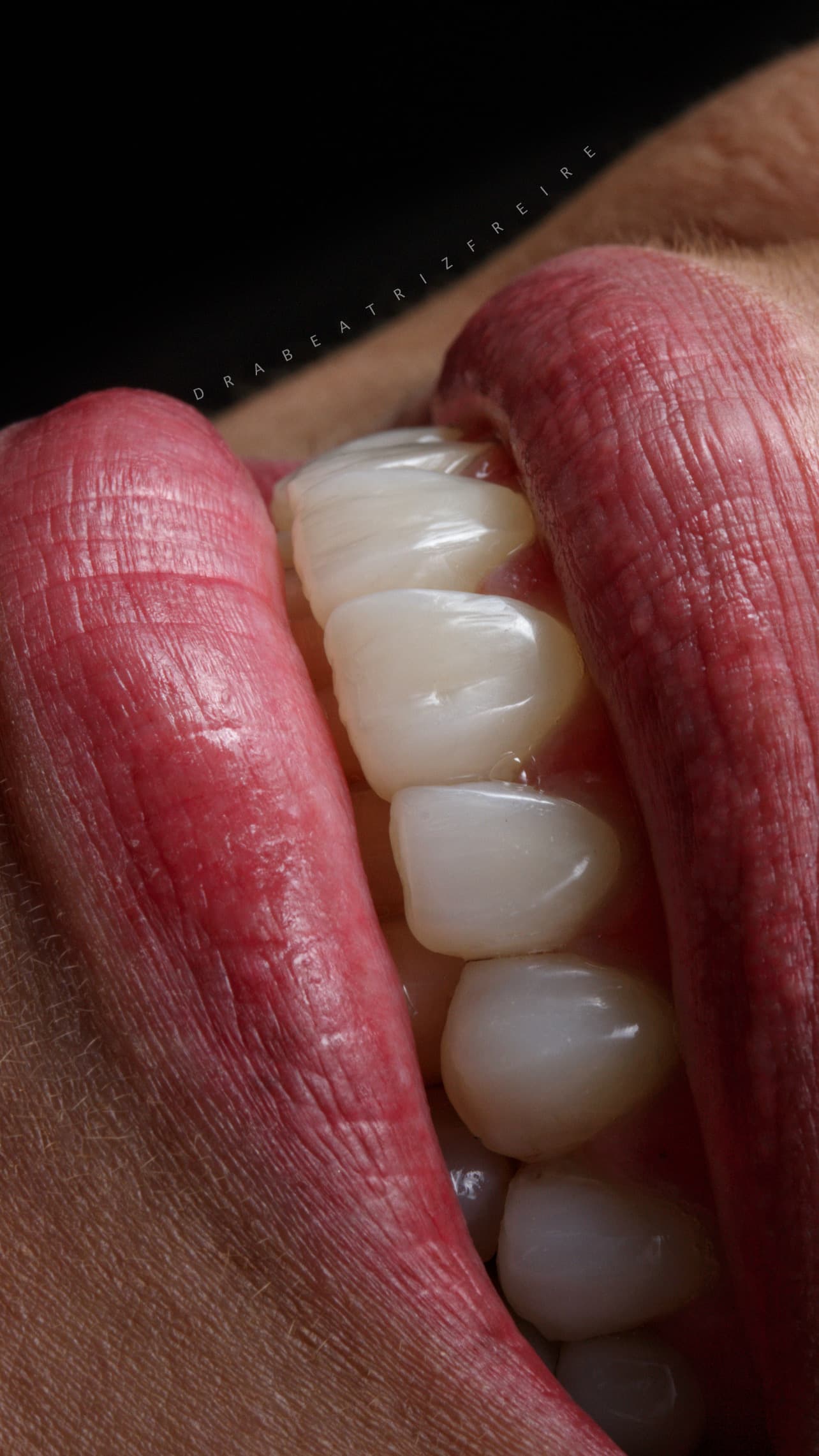 Transformação em Resina - Foto 1