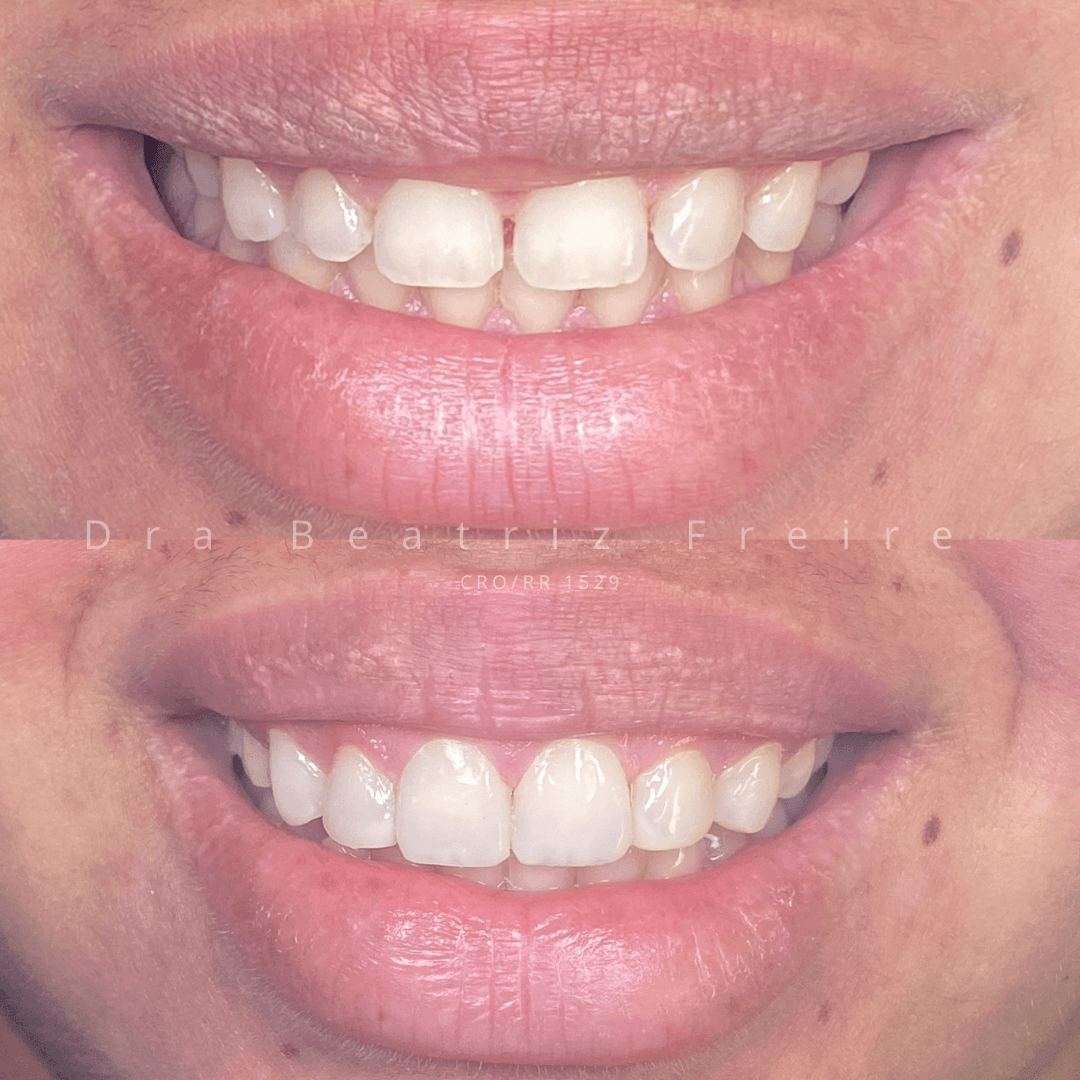 Transformação em Resina - Foto 2