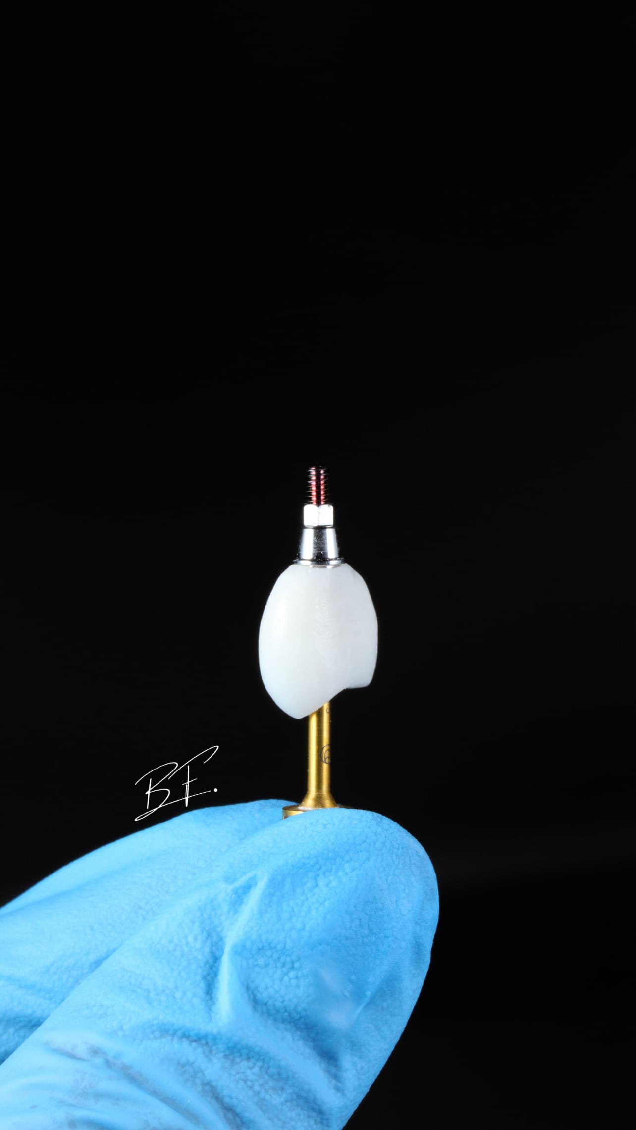 Implante Unitário Estético - Foto 1