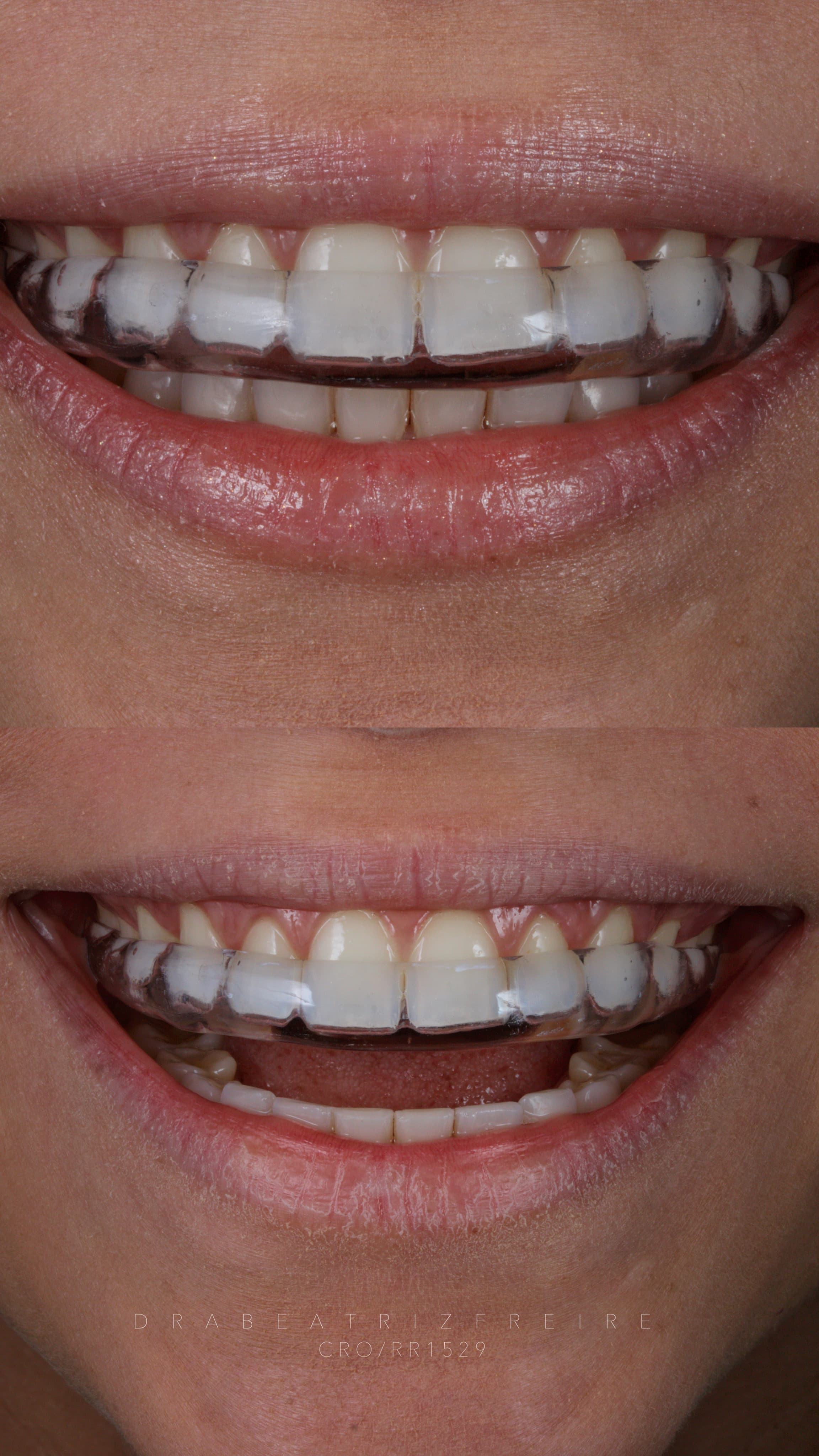 Controle do Bruxismo - Foto 1