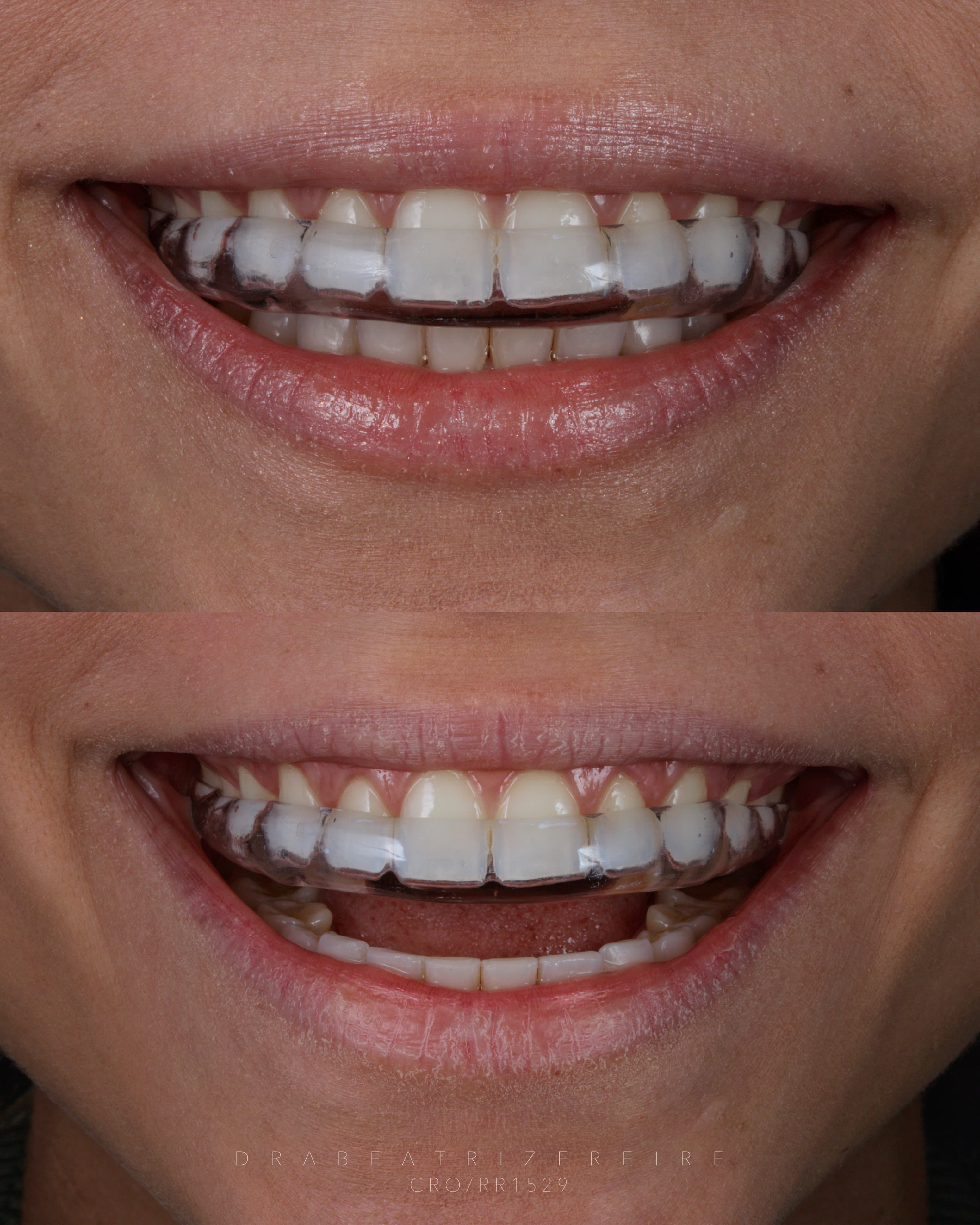 Controle do Bruxismo - Foto 3