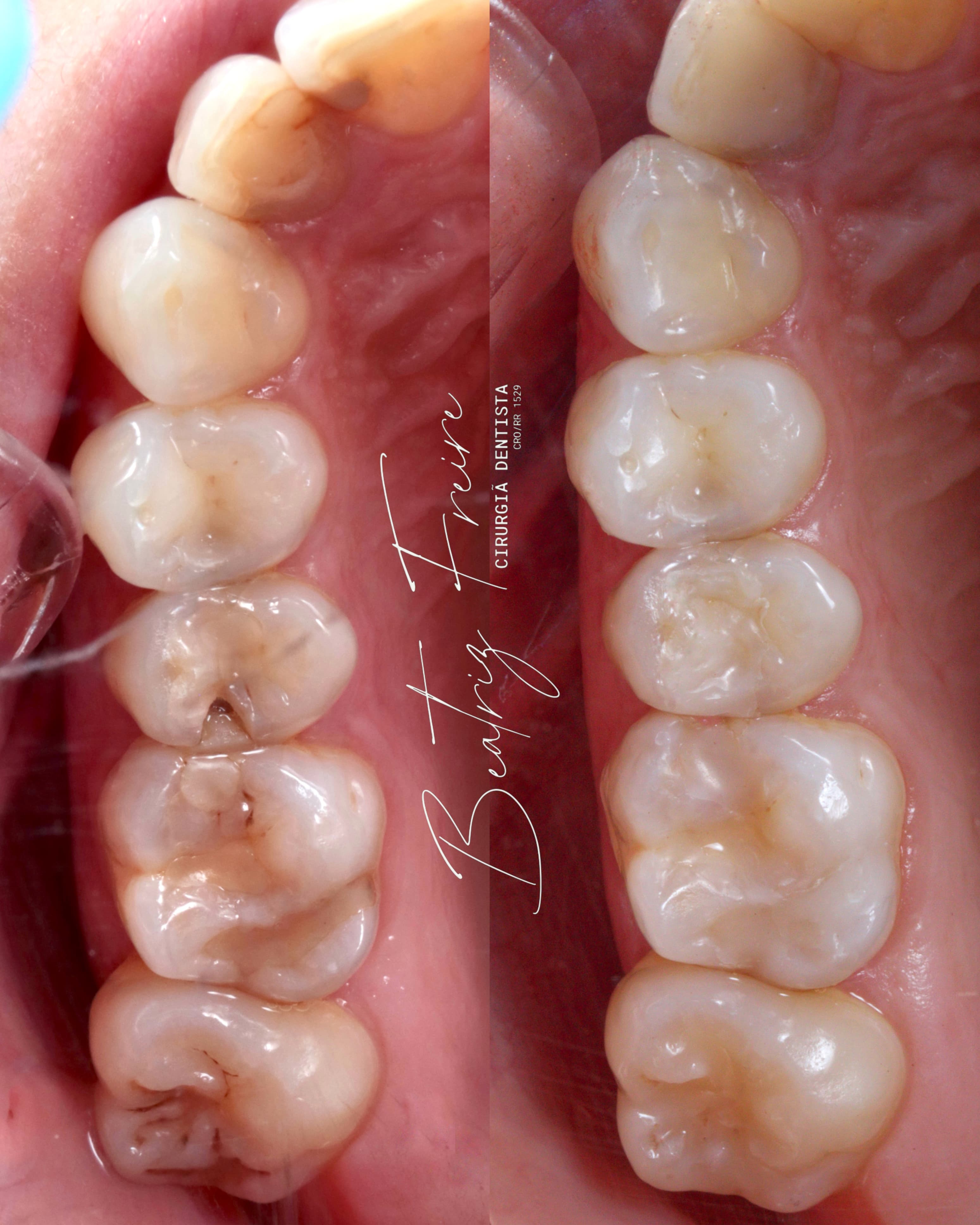 Restauração Estética - Foto 2